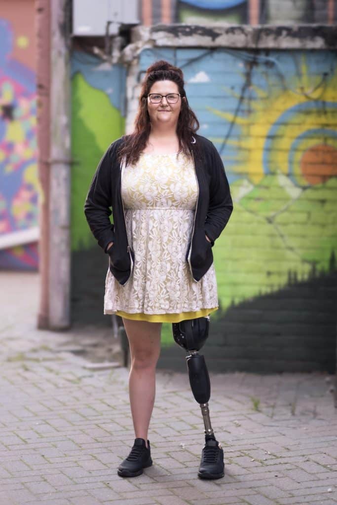 Limb Lab client with an above-knee prosthesis.
